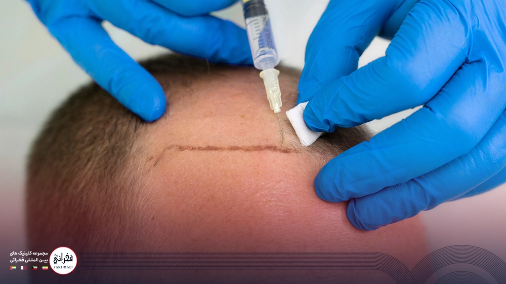 پی‌ آر پی مو-تزریق به جلوی سر آقایی