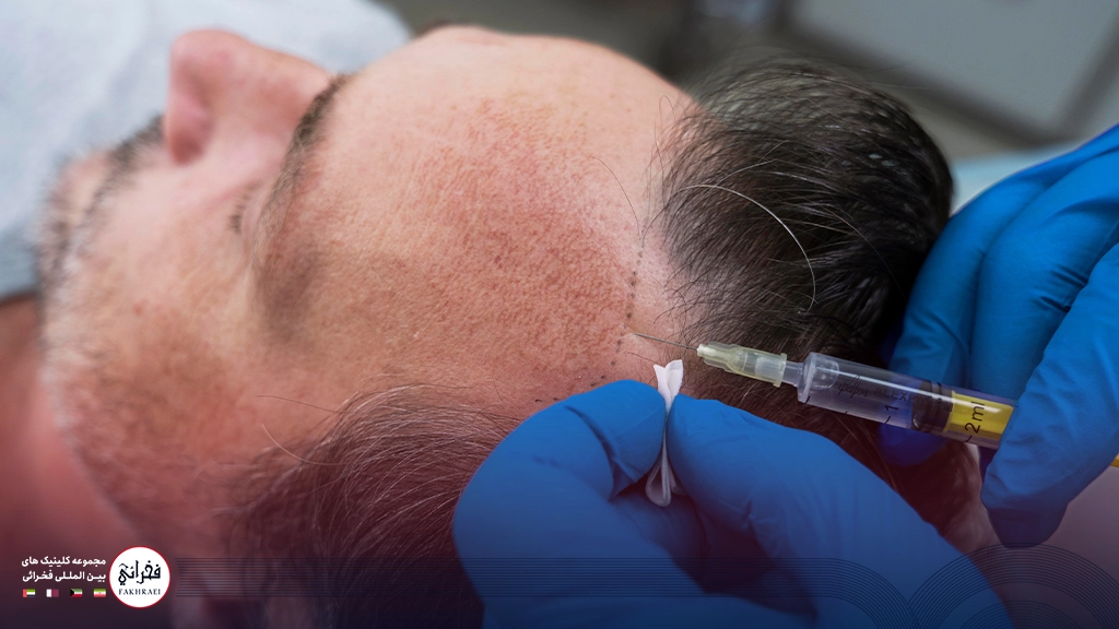پی‌ آر پی مو-تزریق به کف سر مردی