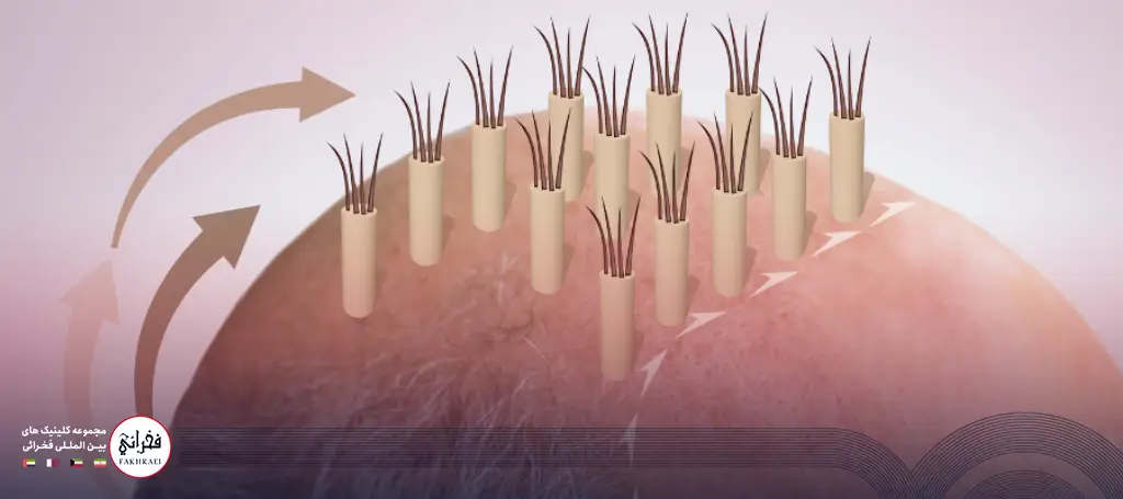 انیمیشن انتقال گرافت مو در فرایند کاشت