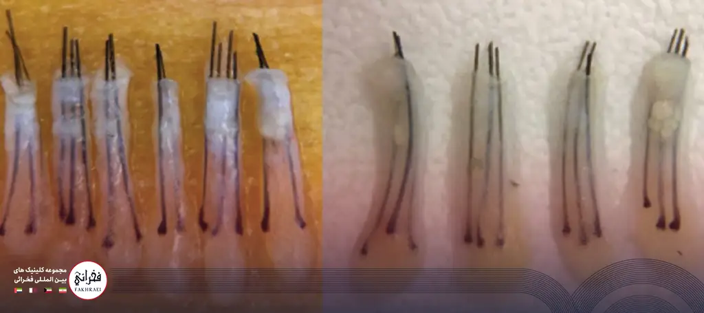 تصویر از گرافتهای استخراج شده برای کاشت مو