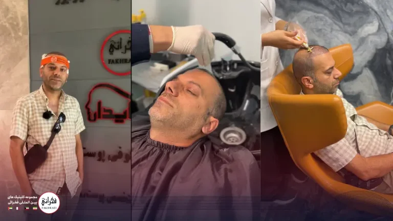 مراقبت های بعد از کاشت مو