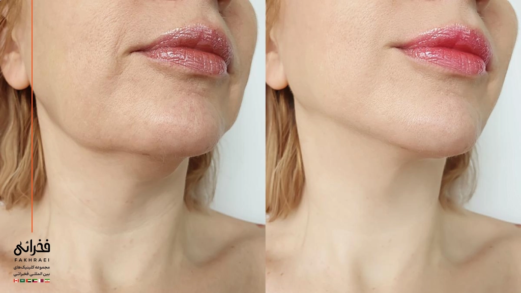 فیلر چانه برای چه کسانی مناسب است؟