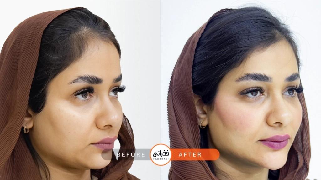 عکس قبل و بعد از فیلر چانه