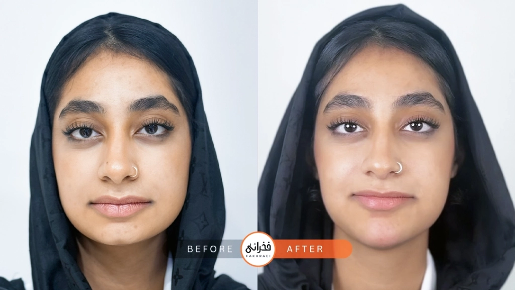 عکس قبل و بعد از فیلر چانه