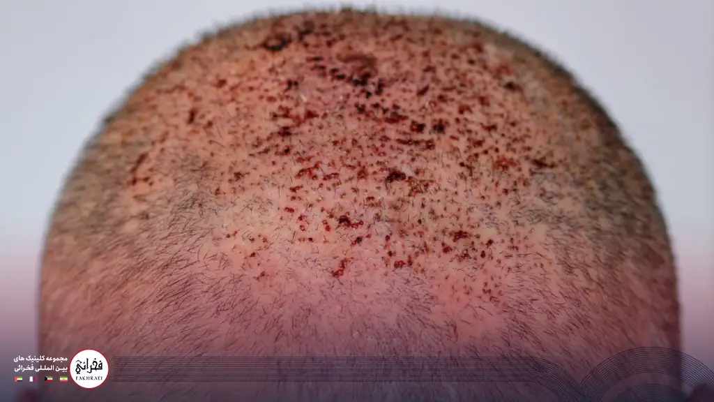 عوارض عدم رعایت مراقبتهای بعد از کاشت مو