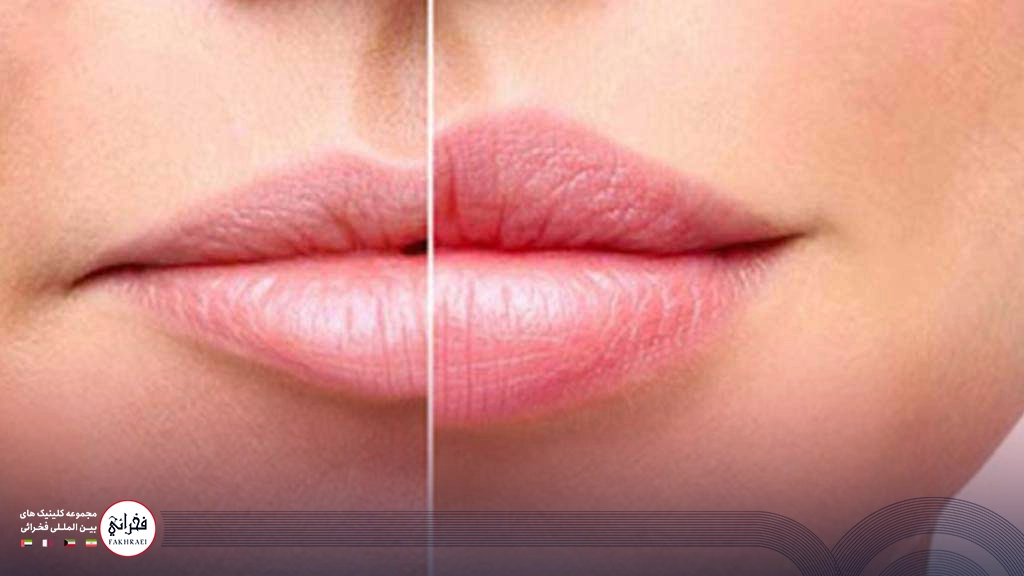تزریق ژل لب مدل چاک دار -لب های خانمی قبل و بعد از تزریق ژل