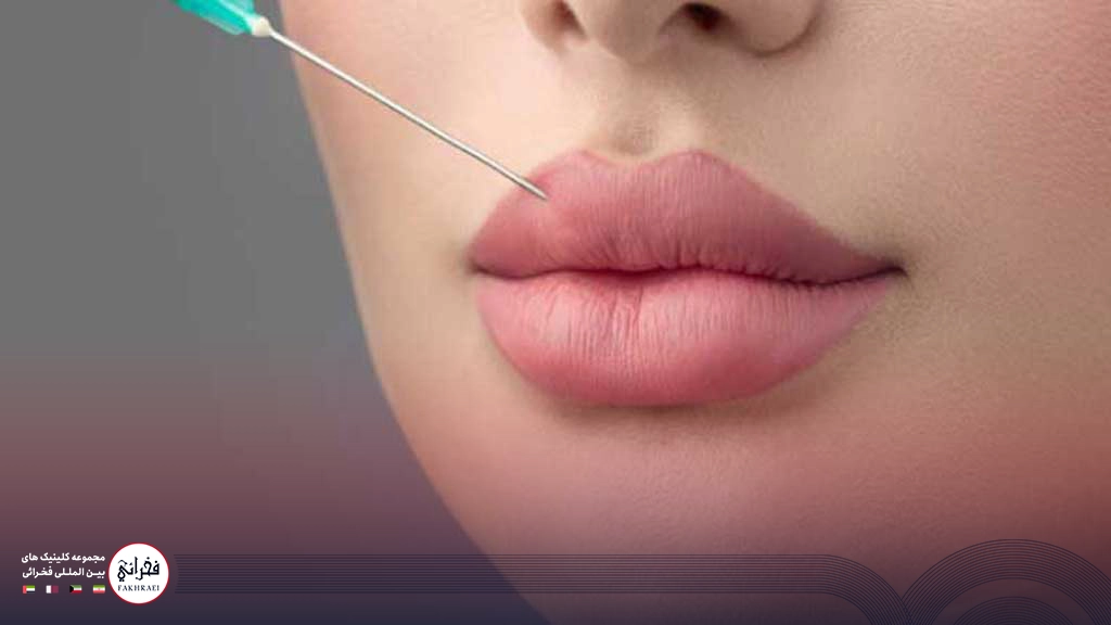 تزریق ژل لب مدل چاک دار -در حال تزریق ژل لب 