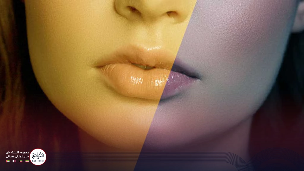 تزریق ژل لب قلبی -لب های ژل زده خانمی