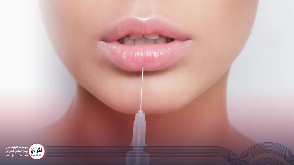 نتیجه تزریق ژل لب مدل روسی روی لب یک زن