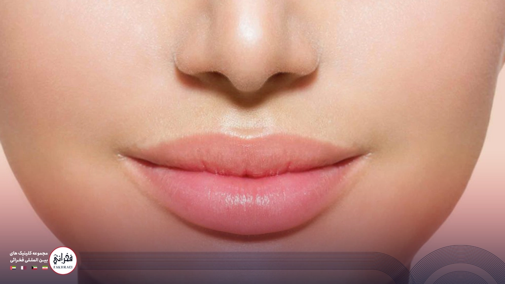 نمونه بعد از تزریق ژل لب روسی