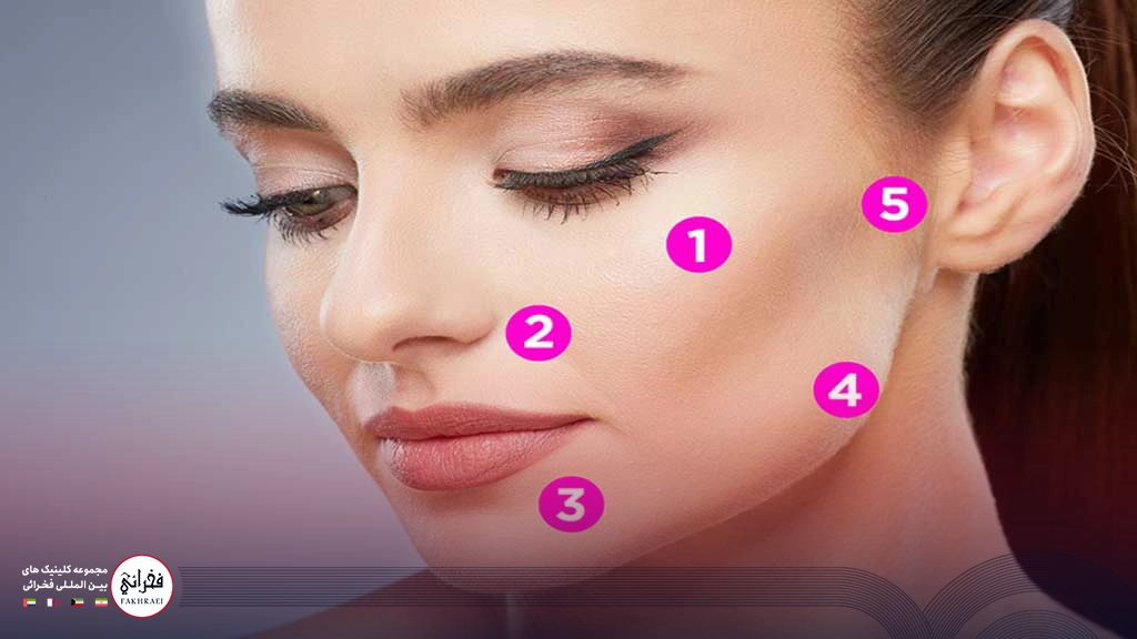 ژل پروفایلو -لیفت صورت