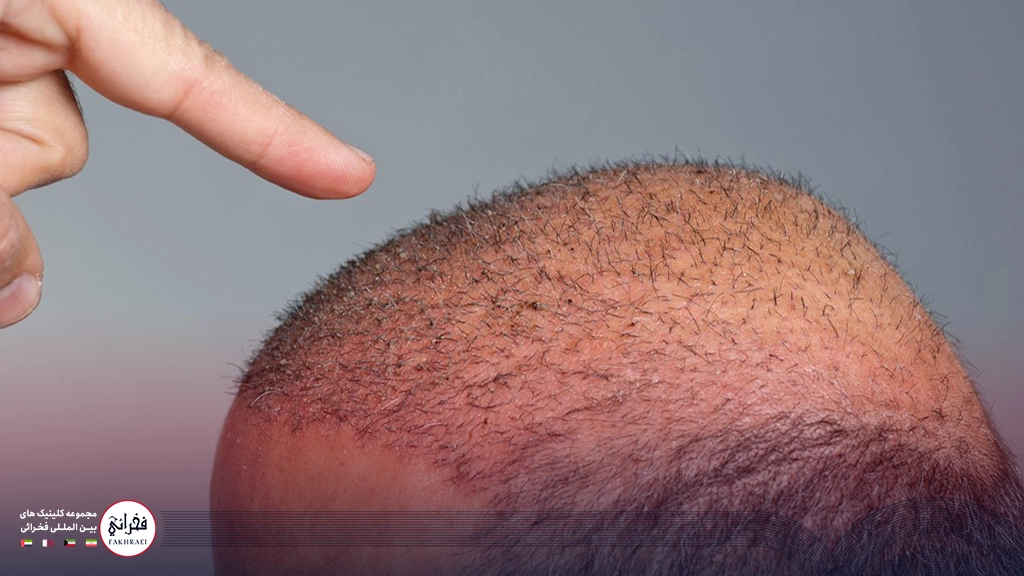 عوارض کاشت مو