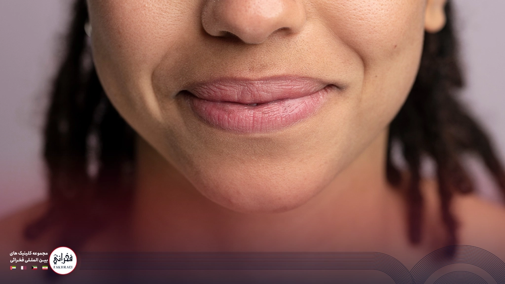 خشکی لب بعد از تزریق ژل-خانومی در حال لبخند