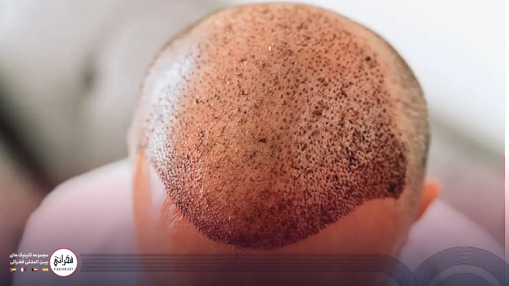 فولیکولیت بعد از کاشت مو