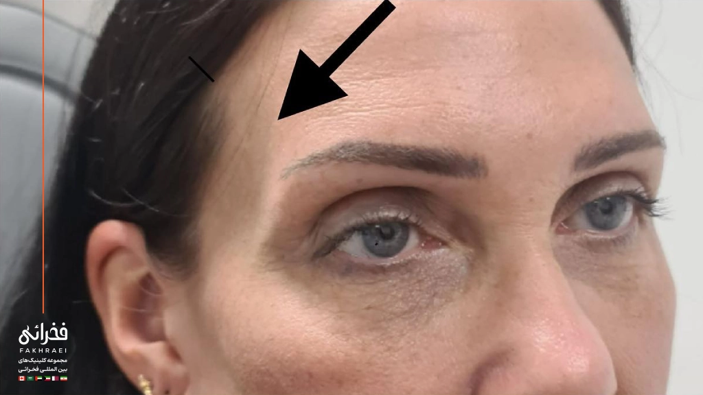 کاربرد فیلر شقیقه