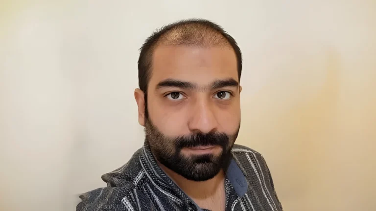 عکس ریزش مو بعد از کاشت