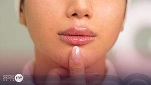 تزریق ژل لب مدل قلوه‌ای