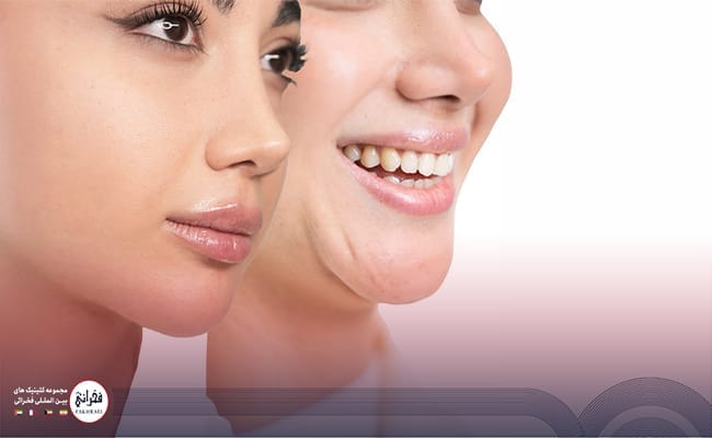 تزریق ژل لب مدل گرد