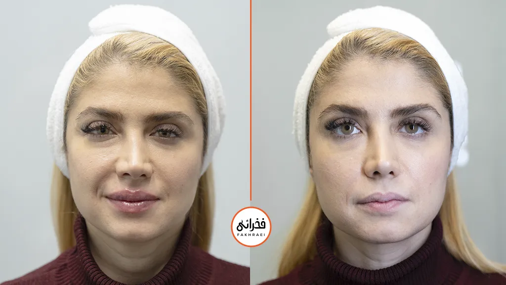 قبل و بعد از تزریق ژل لب یک خانم در کلینیک فخرائی