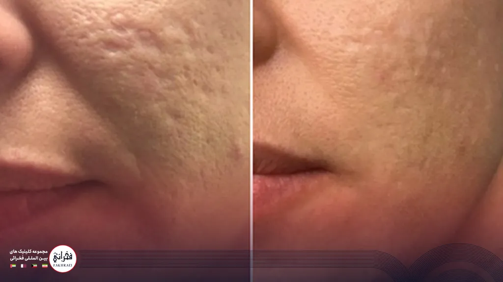 عکس قبل و بعد از پی آر پی صورت