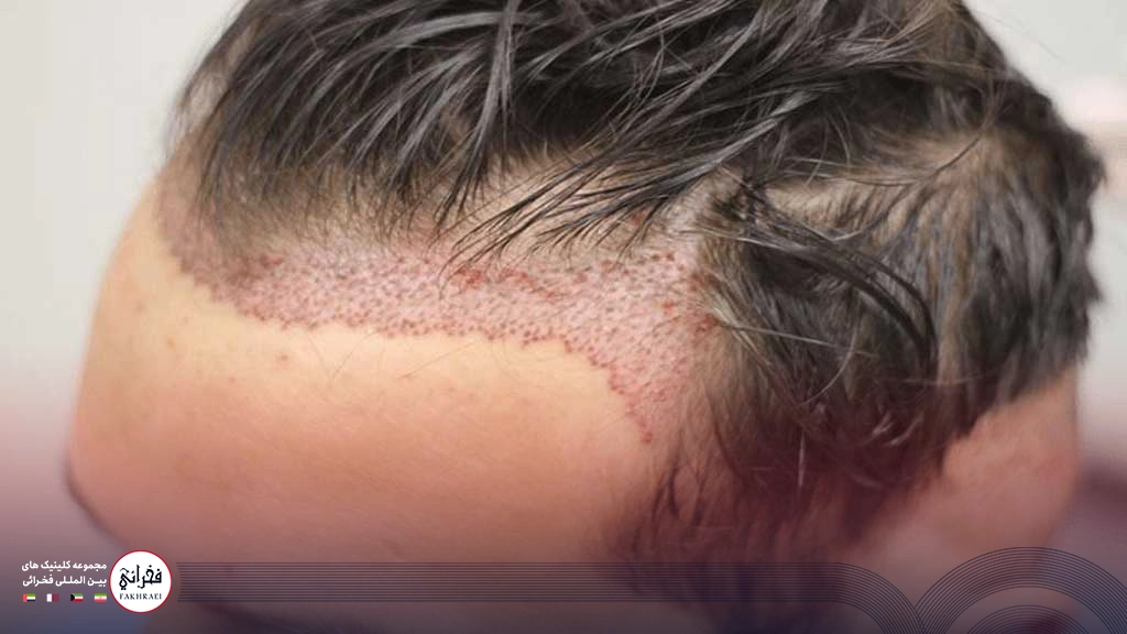 کاشت مو بدون تراشیدن سر -در حال انجام کاشت جلوی سر