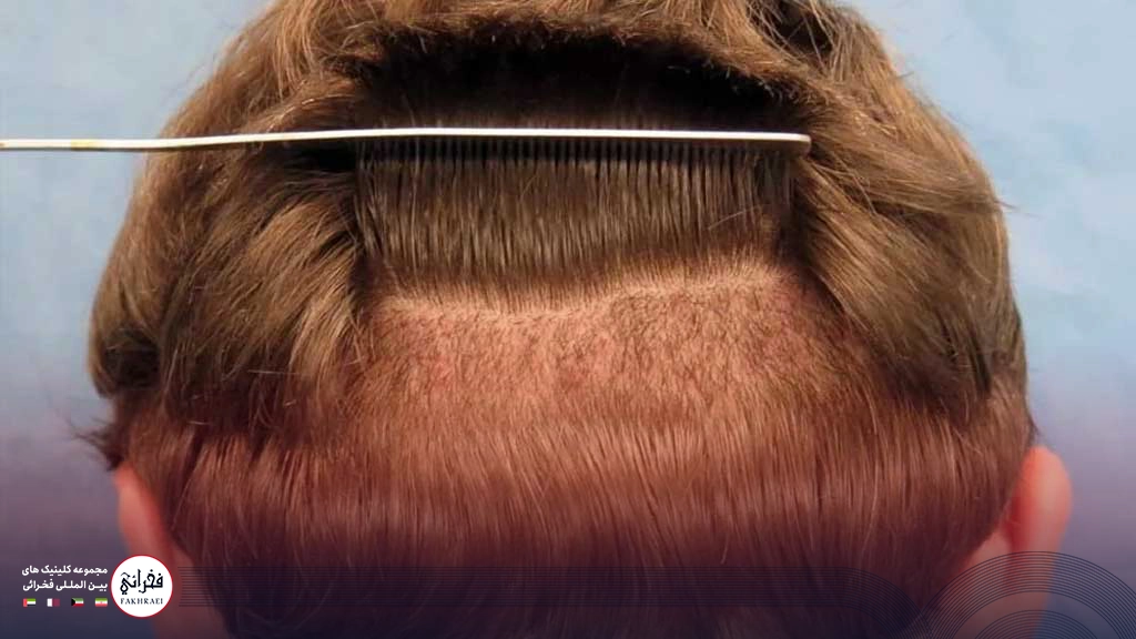 کاشت مو بدون تراشیدن سر