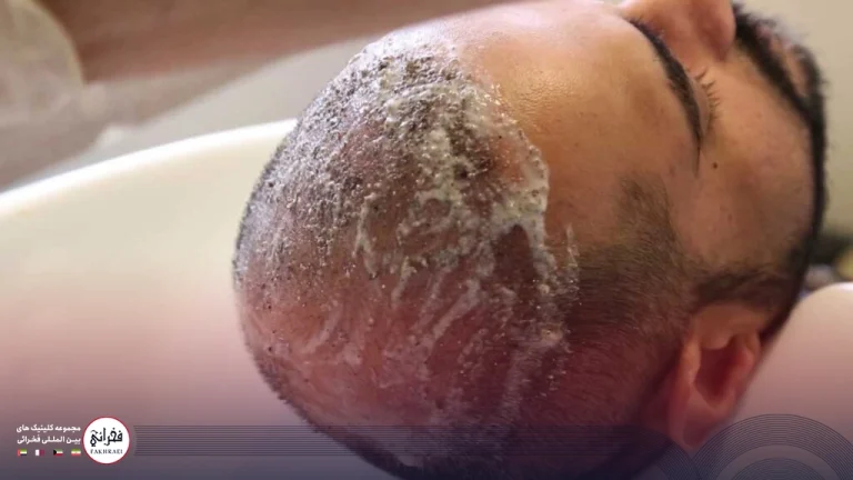 شامپو بعد از کاشت مو