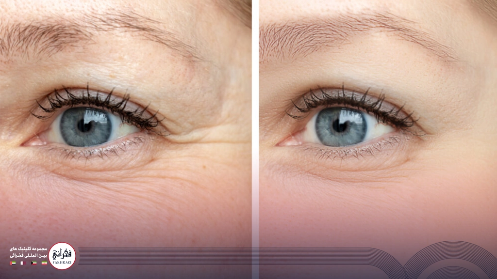 جوانسازی دور چشم-قبل و بعد درمان خطوط پنجه کلاغی
