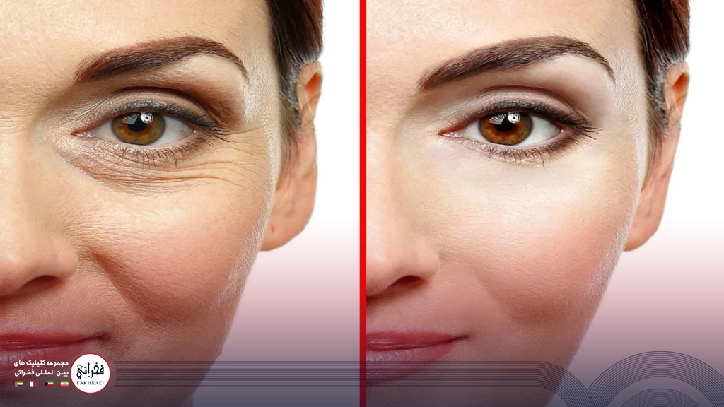جوانسازی دور چشم-قبل و بعد چین و چروک خانومی