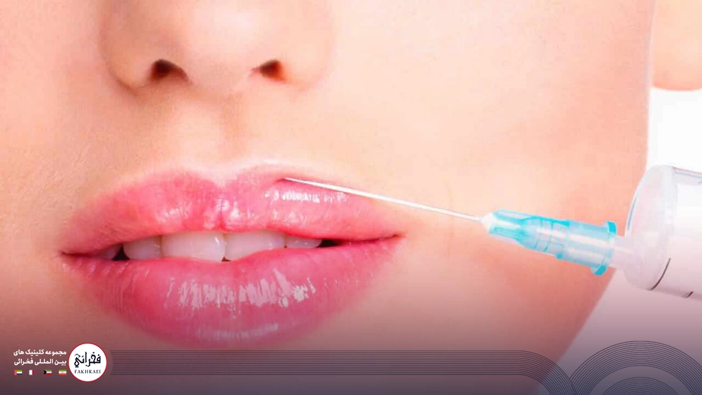 کبودی بعد از تزریق ژل لب-در حال تزریق ژل لب
