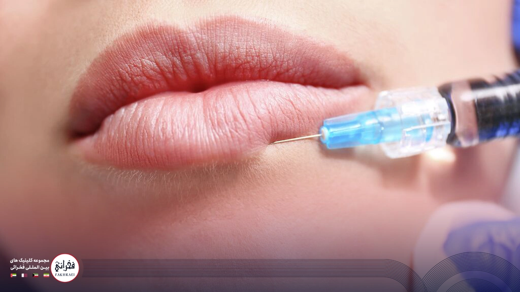 کبودی بعد از تزریق ژل لب-در حال تزریق ژل لب