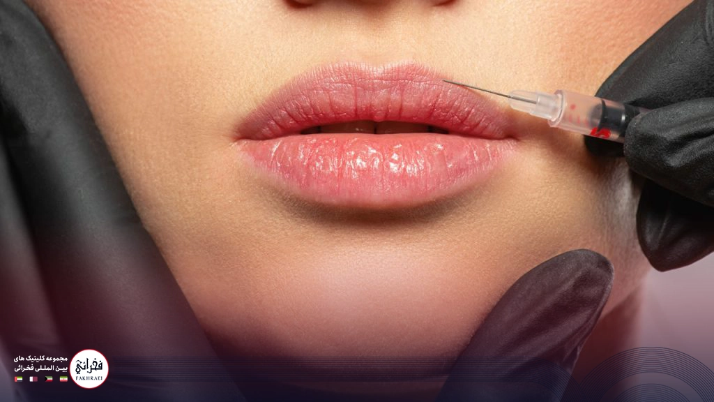 کبودی بعد از تزریق ژل لب-در حال تزریق ژل لب