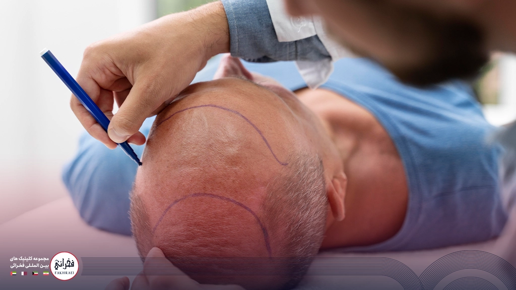 كاشت مو به روش تكثيري