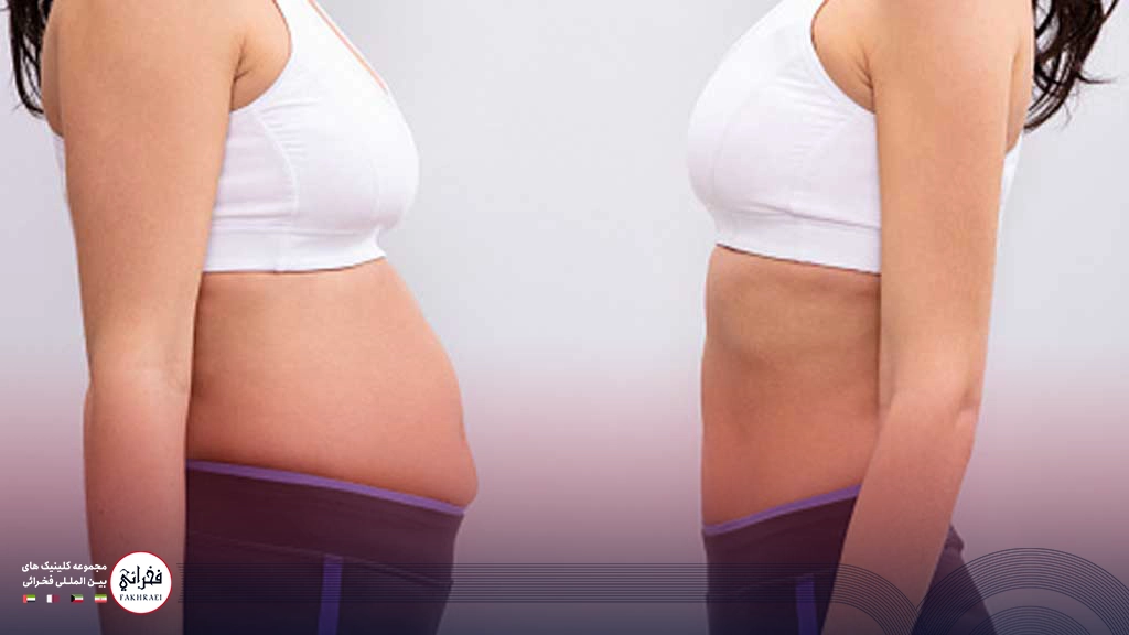 هایفوتراپی شکم-قبل و بعد لاغری شکم