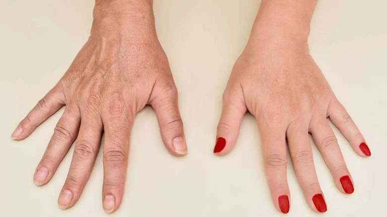 هایفوتراپی دست-نمایی از دست های خانمی