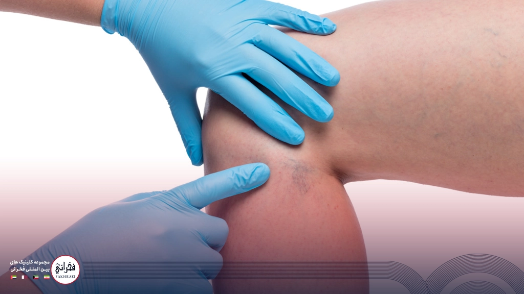 مراقبتهای بعد از اسکلروتراپی