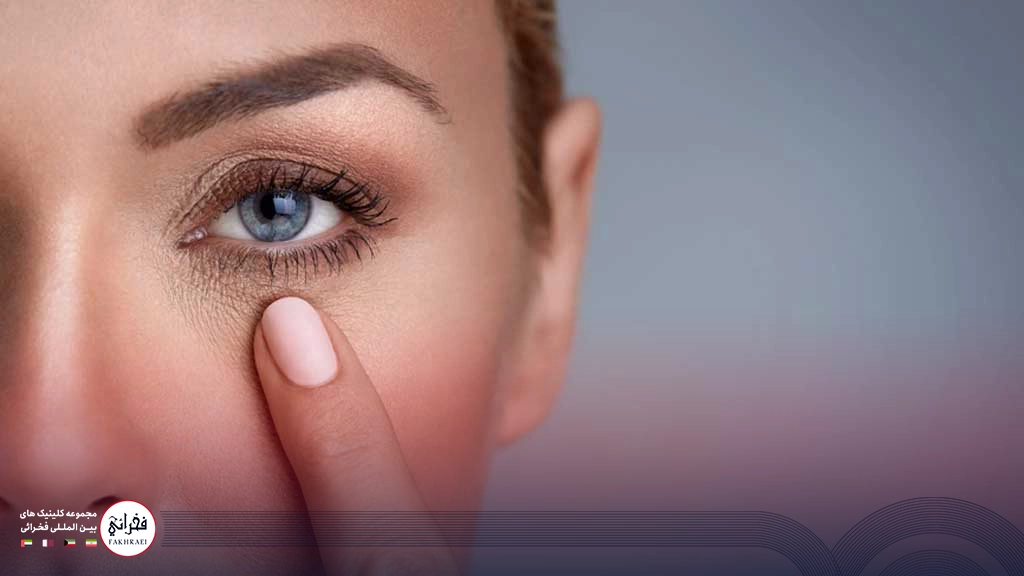 هایفوتراپی دور چشم-دور چشم چروک خانمی با چشمان آبی