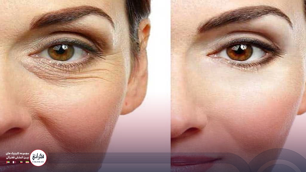 هایفوتراپی دور چشم-قبل و. بعد دور چشم خانمی بعد از هایفو