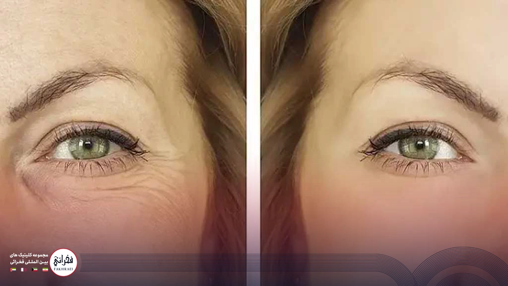 هایفوتراپی دور چشم-قبل و بعد خانمی بعد از هایفو