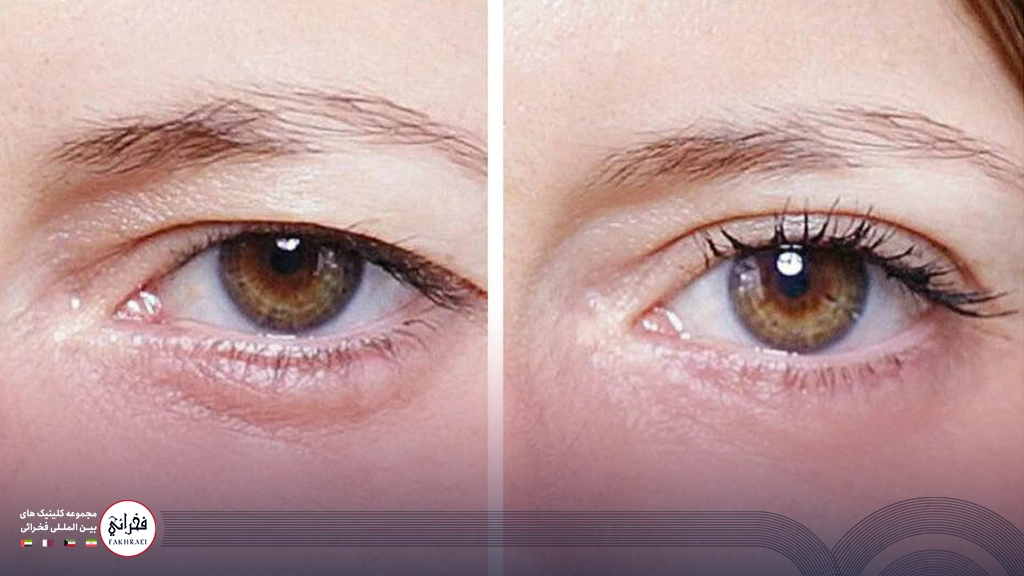 لیفت چشم با نخ -قبال و بعد خانومی بعد از لیفت