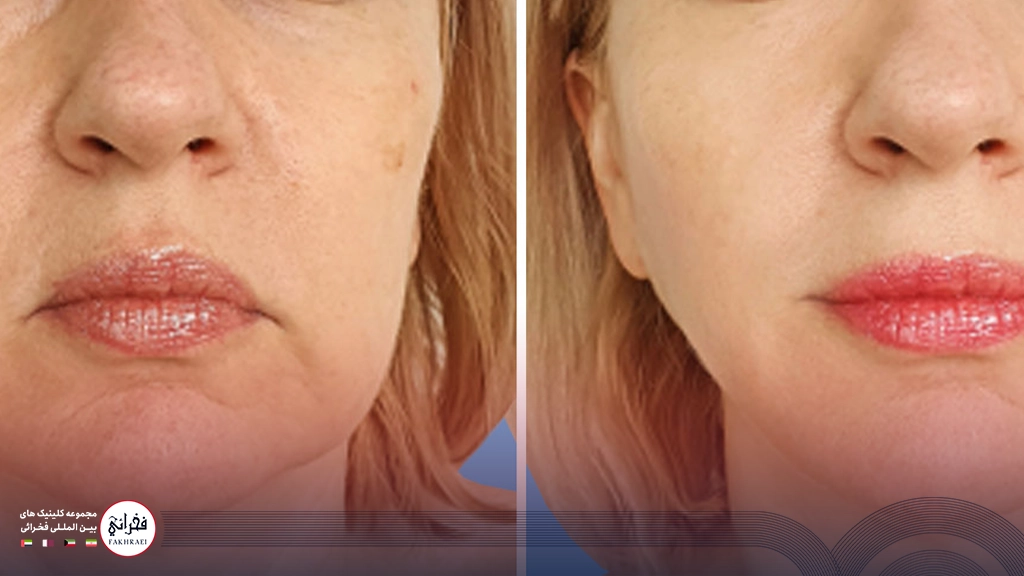 قبل و بعد از لیفت گونه با نخ