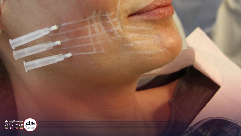 ماندگاری لیفت گونه با نخ