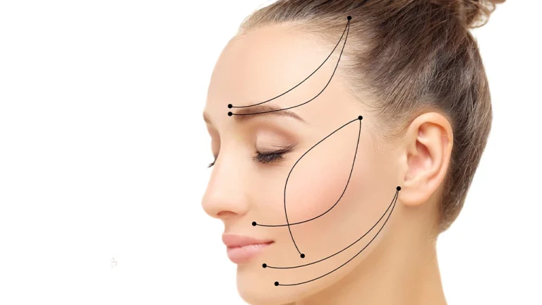 لیفت گونه با نخ