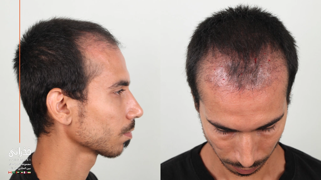 بانک مو ۴۰ روز بعد از کاشت