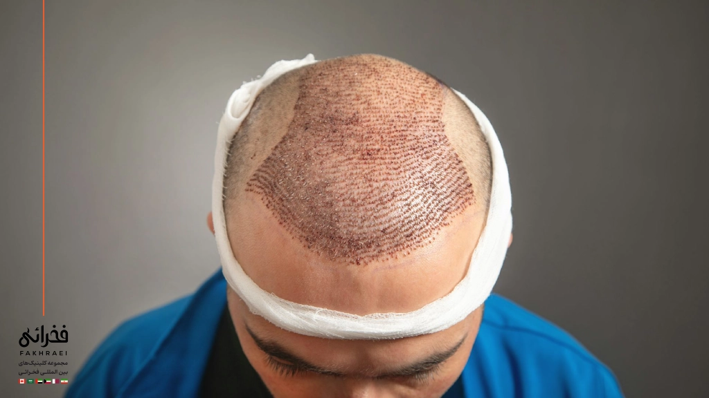 آیا کاشت مو FIT عوارض دارد؟