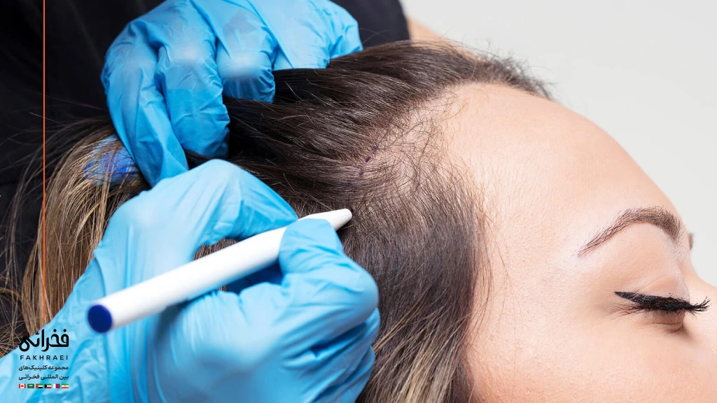 کاشت مو fit برای زنان