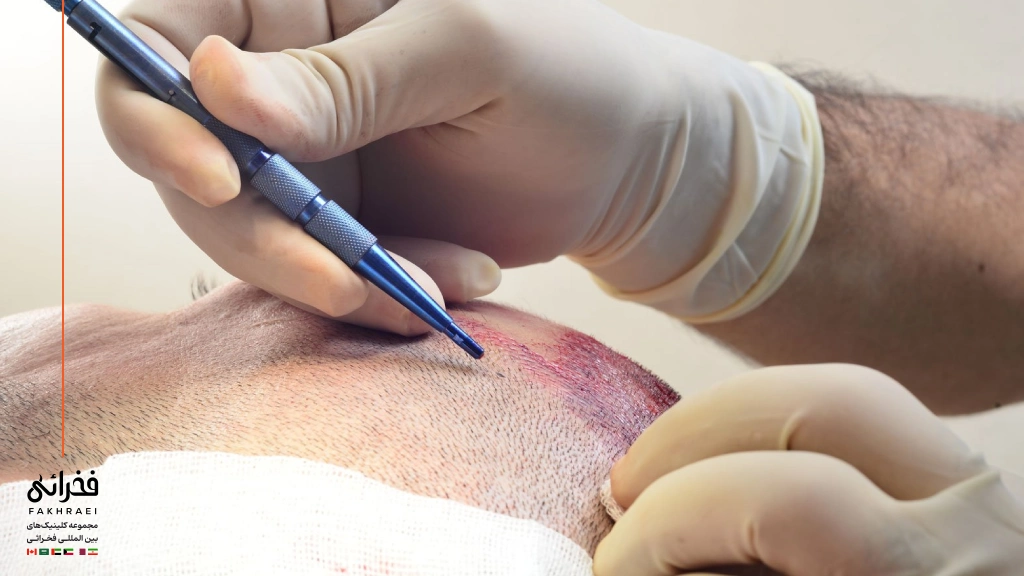 کاشت مو به روش FIT چیست؟