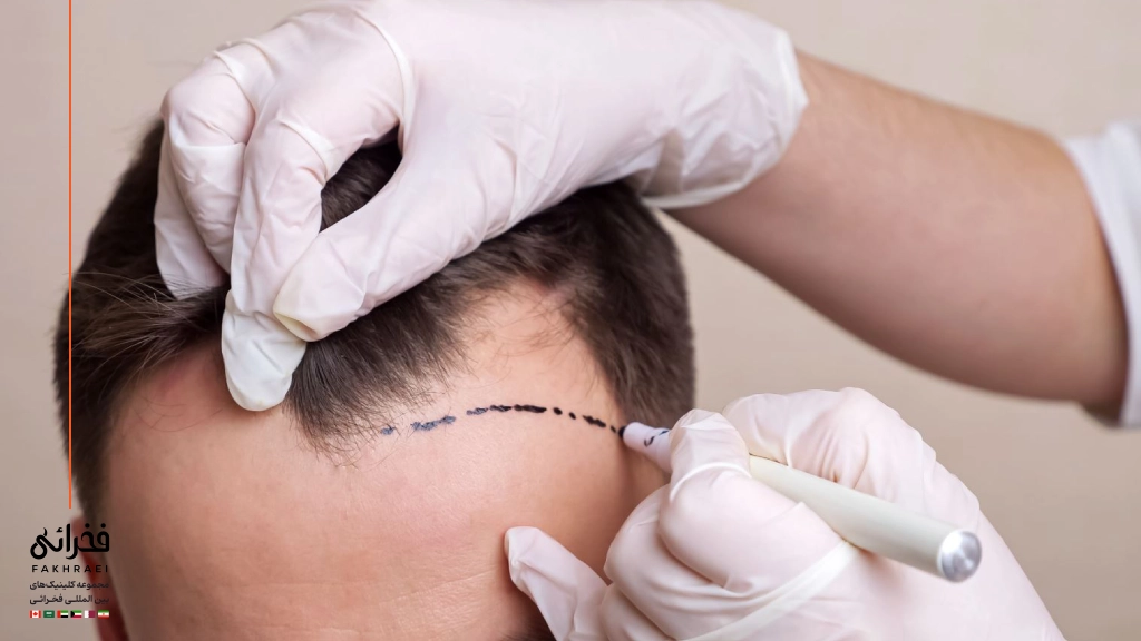 طراحی خط رویش مو