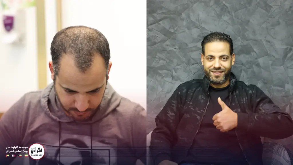 روند رشد مو پس از کاشت