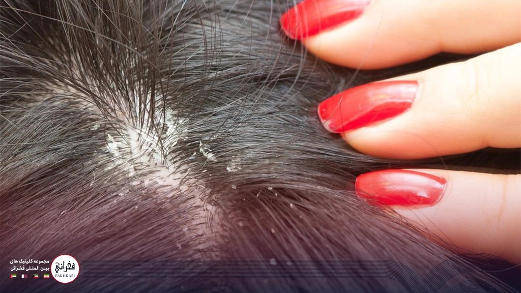 شوره سر خانمی با لاک قرمز